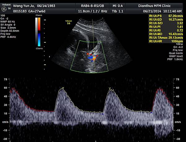 27w6d_右邊子宮動脈血流 