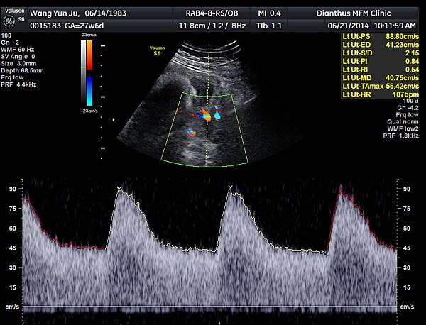27w6d_左邊子宮動脈血流 