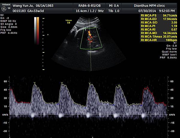 33w3d_胎兒腦血流