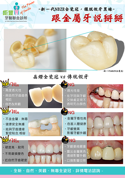 鉅豐全瓷冠 - 2