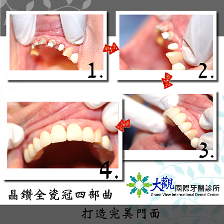 個案範本1