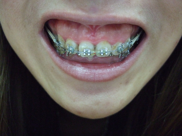 矯正器 恐怖的人中及下巴骨釘 馬尾的城堡 痞客邦