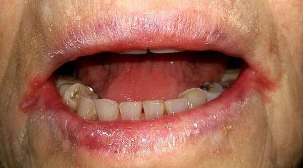Angular_cheilitis1.jpg