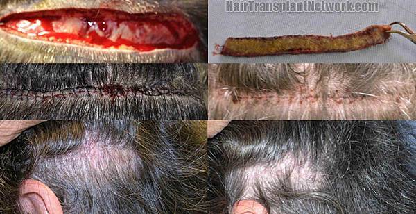 hair-transplant-surgery-pictures-donor-162682