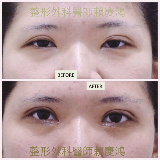 ptosis blepharo revision_Fotor_Fotor