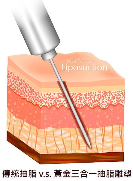 20181116_news-Liposuction-06.jpg