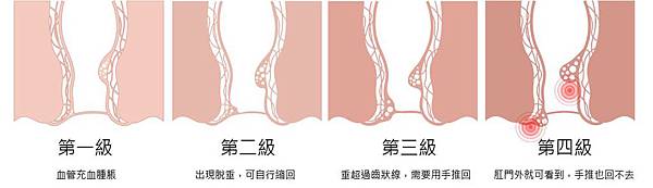 1002-Hemorrhoidectomy-06.jpg