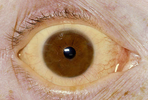 黃疸 護肝食品 肝