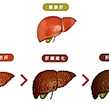 解酒 解宿醉 護肝 酒精肝 脂肪肝 肝硬化 利九星