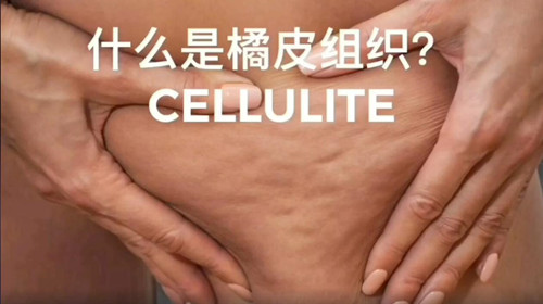 什麼是橘皮組織_副本 什麼是橘皮組織_副本
