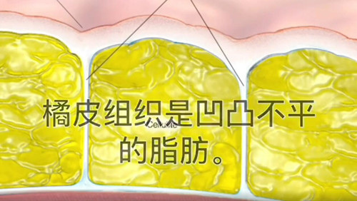 什麼是橘皮組織1_副本 什麼是橘皮組織1_副本