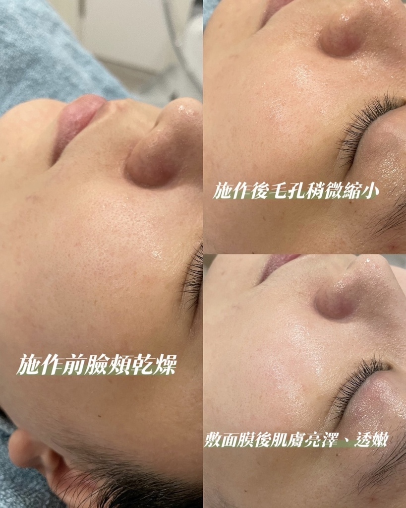 醫美|完全無侵入性,完美打造日常Q彈肌!皙妍診所無創美妍QQ