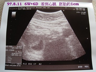 6W+6D 胚胎1cm看到心跳嚕