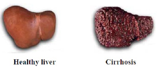 Liver Cirrhosis1.jpg