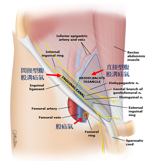 疝氣1.png