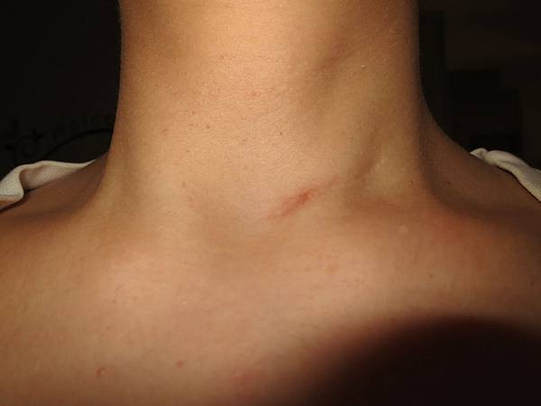 20120910甲狀腺 20120910甲狀腺