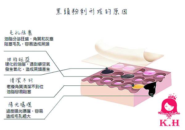 黑頭形成圖1.jpg