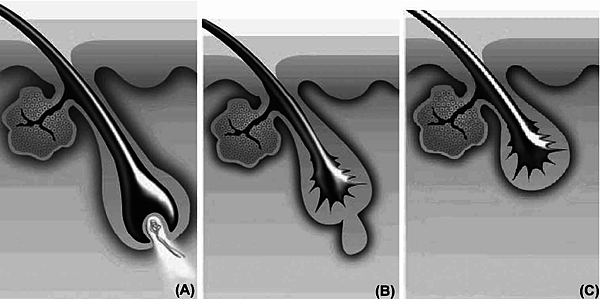 Hair-follicle-cycle-A-Anagen-phase-hair-matrix-cells-migrate-outward-from-the-shaft.png