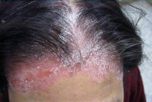 性体质  •接触特殊化学物质  •须注意皮癣菌感染的可能性