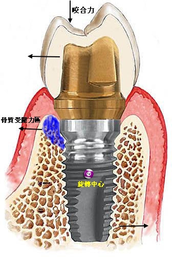 implant - 3.jpg