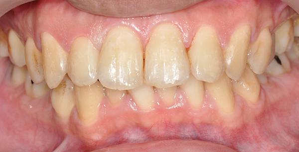 [牙齒美白] 甚麼是牙齒噴砂美白 高雄牙醫  牙齒美白推薦