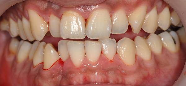 [牙齒美白] 甚麼是牙齒噴砂美白 高雄牙醫  牙齒美白推薦