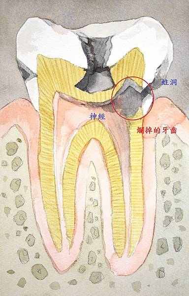 爛掉的牙齒.jpg