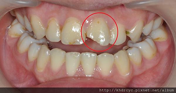 前牙斷裂2