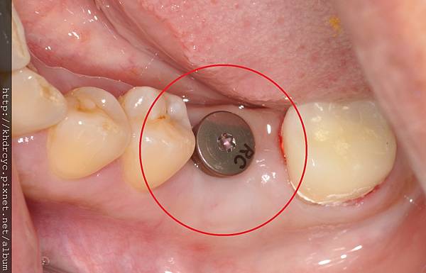 高雄牙醫/左營牙醫/牙醫推薦/高雄植牙 高雄牙醫/左營牙醫/牙醫推薦/高雄植牙