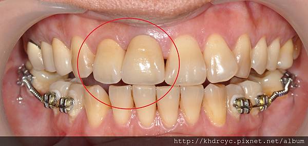 前牙變色後牙矯正8