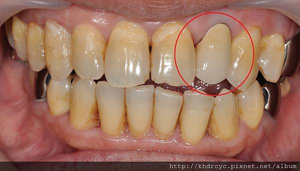 高雄牙醫/左營牙醫/牙醫推薦/高雄植牙 高雄牙醫/左營牙醫/牙醫推薦/高雄植牙