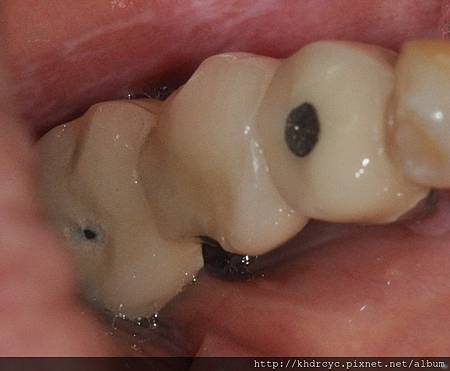 高雄牙醫/左營牙醫/牙醫推薦/高雄植牙 高雄牙醫/左營牙醫/牙醫推薦/高雄植牙