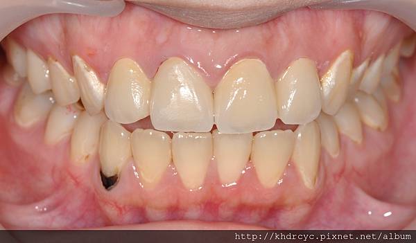 高雄牙醫/左營牙醫/牙醫推薦/高雄植牙 高雄牙醫/左營牙醫/牙醫推薦/高雄植牙