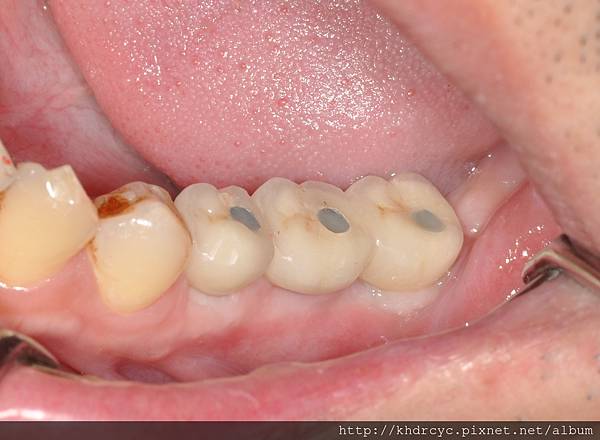 高雄牙醫/左營牙醫/牙醫推薦/高雄植牙 高雄牙醫/左營牙醫/牙醫推薦/高雄植牙