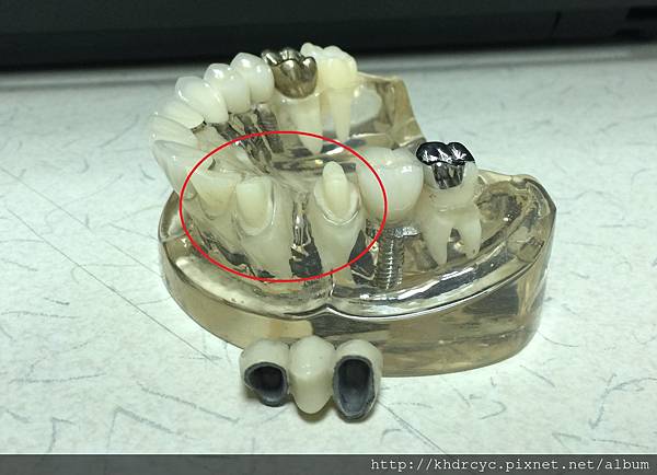 高雄牙醫/左營牙醫/牙醫推薦/高雄植牙 高雄牙醫/左營牙醫/牙醫推薦/高雄植牙