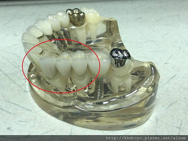 高雄牙醫/左營牙醫/牙醫推薦/高雄植牙 高雄牙醫/左營牙醫/牙醫推薦/高雄植牙