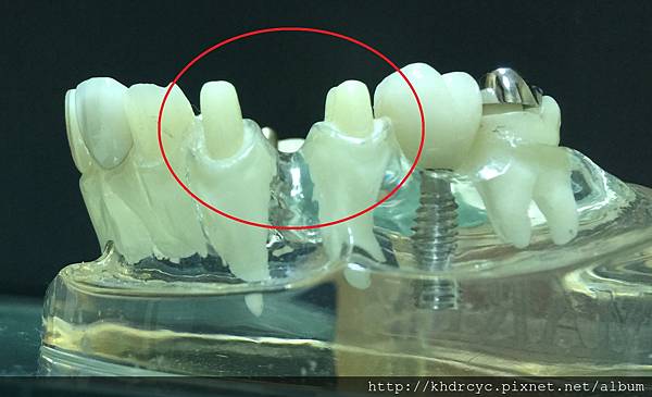 高雄牙醫/左營牙醫/牙醫推薦/高雄植牙 高雄牙醫/左營牙醫/牙醫推薦/高雄植牙