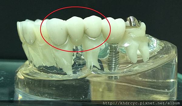 高雄牙醫/左營牙醫/牙醫推薦/高雄植牙 高雄牙醫/左營牙醫/牙醫推薦/高雄植牙