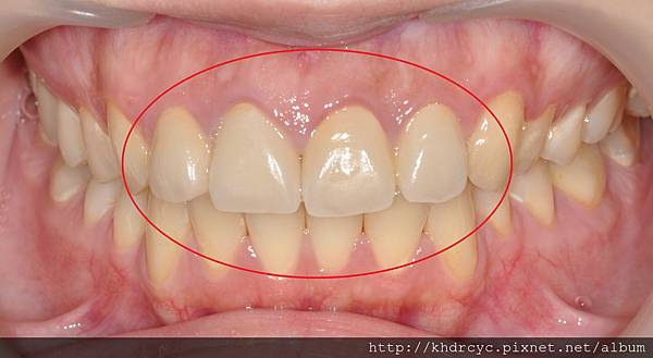 高雄牙醫/左營牙醫/牙醫推薦/高雄植牙 高雄牙醫/左營牙醫/牙醫推薦/高雄植牙