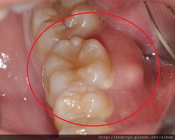 高雄牙醫/左營牙醫/牙醫推薦/高雄植牙 高雄牙醫/左營牙醫/牙醫推薦/高雄植牙