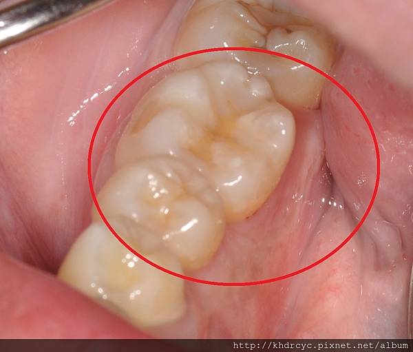 高雄牙醫/左營牙醫/牙醫推薦/高雄植牙