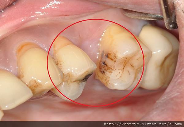 高雄牙醫/左營牙醫/牙醫推薦/高雄植牙 高雄牙醫/左營牙醫/牙醫推薦/高雄植牙