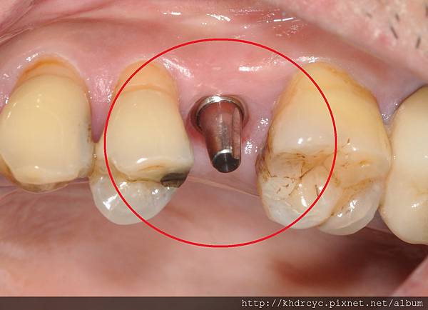 高雄牙醫/左營牙醫/牙醫推薦/高雄植牙 高雄牙醫/左營牙醫/牙醫推薦/高雄植牙