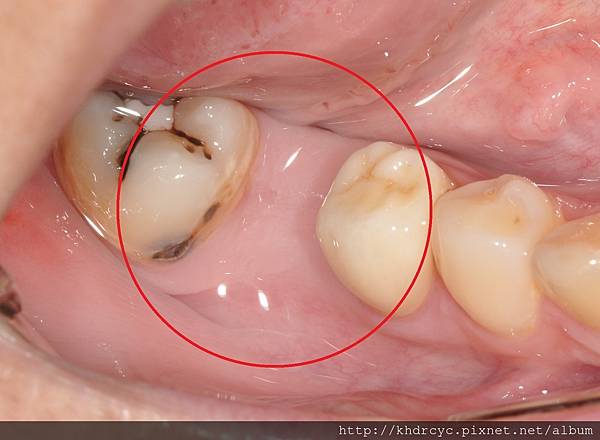 高雄牙醫/左營牙醫/牙醫推薦/高雄植牙 高雄牙醫/左營牙醫/牙醫推薦/高雄植牙