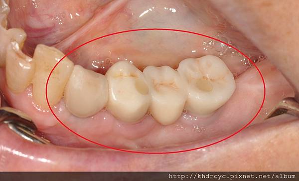 高雄牙醫/左營牙醫/牙醫推薦/高雄植牙 高雄牙醫/左營牙醫/牙醫推薦/高雄植牙