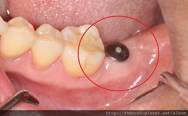 高雄牙醫/左營牙醫/牙醫推薦/高雄植牙 高雄牙醫/左營牙醫/牙醫推薦/高雄植牙