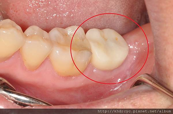 高雄牙醫/左營牙醫/牙醫推薦/高雄植牙 高雄牙醫/左營牙醫/牙醫推薦/高雄植牙