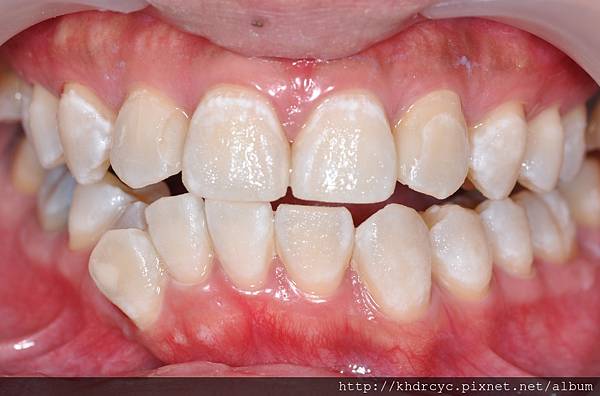 [牙齒美白] 甚麼是冷光美白 高雄牙醫 牙齒美白推薦