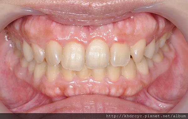 高雄牙醫/左營牙醫/牙醫推薦/高雄植牙 高雄牙醫/左營牙醫/牙醫推薦/高雄植牙