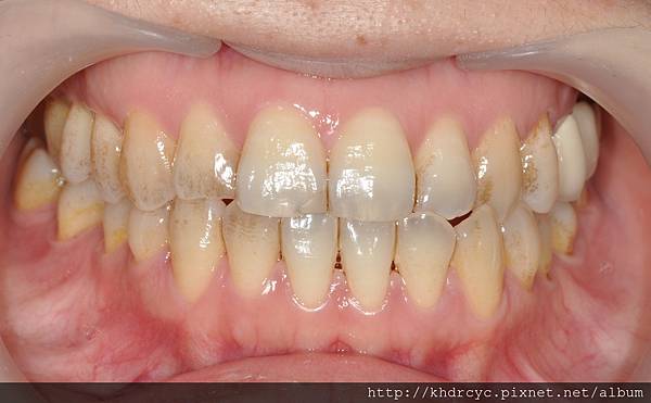 高雄/牙醫/推薦/左營/美白/植牙